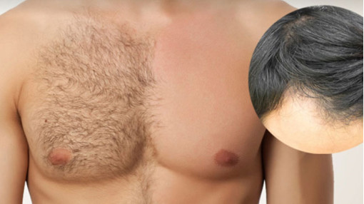 BHT- Body Hair Transplant