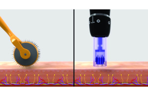 Mesotherapy